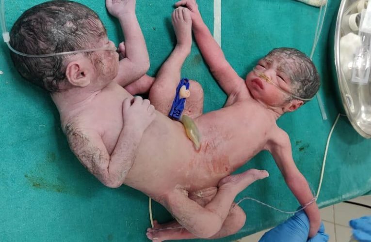धड़ से आपस में जुड़े जुड़वा बच्चे नें लिया जन्म.