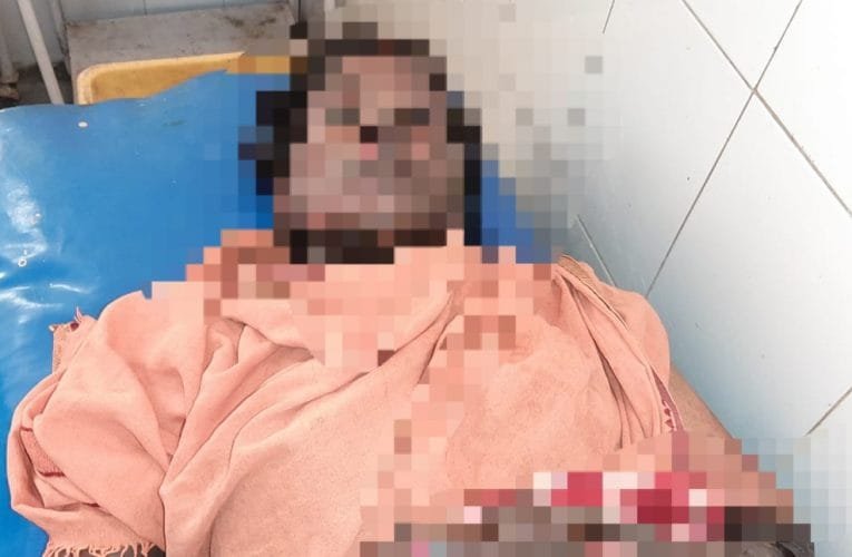 गैस चूल्हे से झुलसी महिला, हुई घायल.