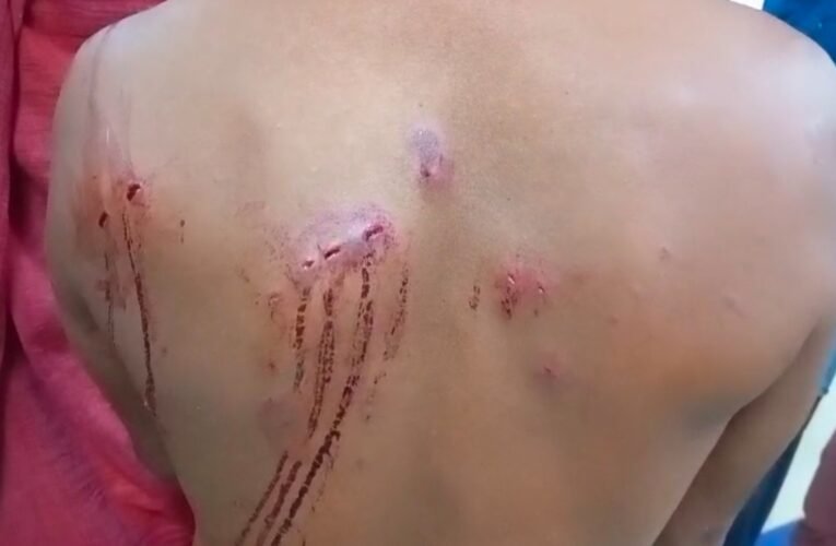 बोकारो में झोला छाप डॉक्टर ने क्या कर डाला: 200 रुपये बकाया न देने पर मरीज पर कैंची इलाज !