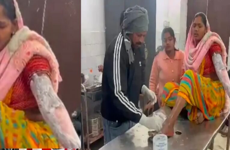 गिरिडीह में छेड़खानी का विरोध करने पर महिला पर उबलता तेल फेंका, महिला झुलसी